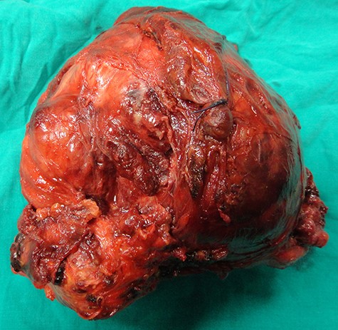 The mass following complete resection.