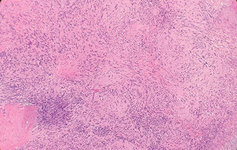 Microscopic examination reveals that tumor composed of biphasic spindle hypercellular Antoni A areas and hypocellular Antoni B areas (×2).