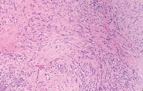 Higher magnification reveals spindle tumor cells are narrow, elongate, wavy with tapered ends interspersed with collagen fibers (×20).