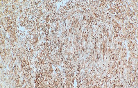 Immunohistochemical staining revealed that tumor cells are strongly positive for S-100 protein (×40).
