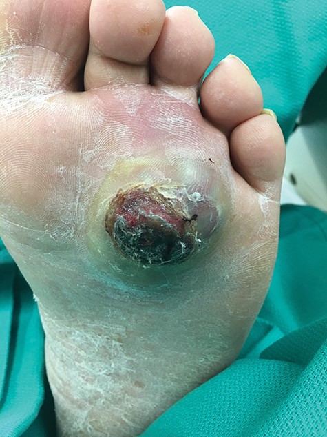 At presentation, the lesion appeared as a variably ‘hyperkeratotic mass with deep ulceration’.