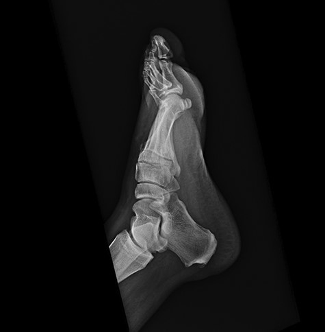 Initial x-ray of the foot was interpreted as ‘soft tissue swelling of the foot’.