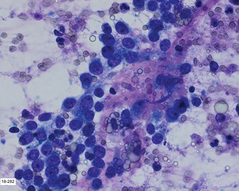 Touch prep of the excised lesion, prepared intraoperatively, showed loosely cohesive malignant neoplastic cells with small hyperchromatic nuclei and scant cytoplasm suspicious for a small round cell tumor.