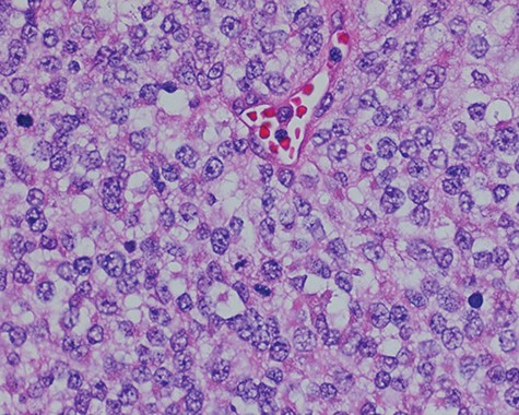 Sections of the lesion consist predominantly of sheets of poorly differentiated malignant neoplastic cells with moderately pleomorphic vesicular nuclei, clear cytoplasm, and abundant mitotic activity.