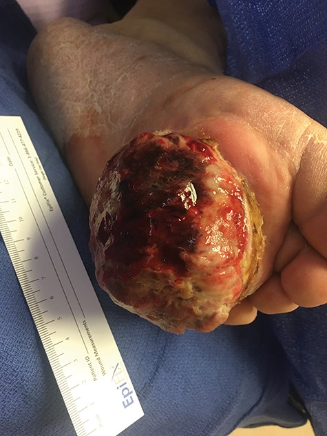 Two months following the excision, the patient presented with a significantly enlarged, necrotic and ulcerated tumor at the excision site.