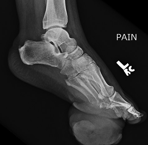 Repeat lateral X-ray views of the foot, 2 months later, showed ‘interval appearance of large soft tissue mass, plantar to the phalanges’. The differential diagnostic consideration by the imaging studies included ‘phlegmon, abscess, hematoma, or less likely a rapidly growing neoplasm’.