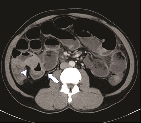 High grade SBO with a transition point within the right lower quadrant in distal ileum (arrow). The bowel loop in this region demonstrates significantly asymmetric irregular wall thickening (arrowhead).