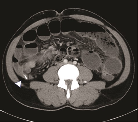 There is an appendicolith noted within the proximal appendix which is mildly thickened measuring up to 8 mm (arrowhead).
