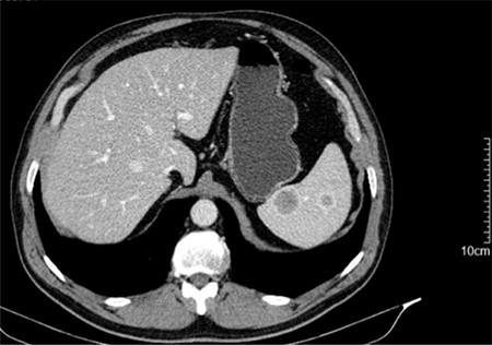 CT scan showing two of the five ring-enhancing nodular lesions.