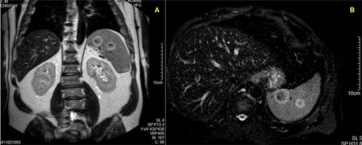 MR Imaging showing two nodular formations with the same ring-hypersignal pattern; A—T1-weighted acquisition; B—T2-weighted acquisition.