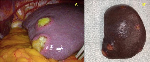 A′—Macroscopic view of the spleen during the laparoscopic splenectomy, where two nodular yellow formations can be seen arising from the capsule, and B′—after resection.