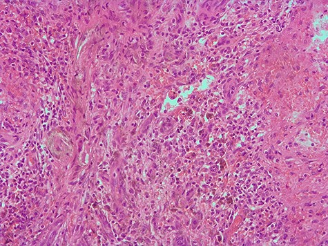 Hematoxylin and eosin 200X, area of the biggest lesion composed mainly by abundant capillaries.