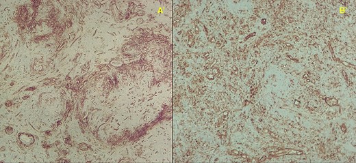 Immunohistochemistry stainings showing abundant capillaries; A′—CD34+ 40X and B′—CD31+ 100X magnification, respectively.