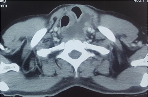 CECT of neck. Note the upper end of the pyocele displacing the trachea and the gastric conduit anteriorly and towards the right.