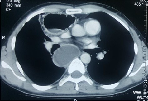CECT of the chest. Note the huge pyocele posteriorly and the gastric conduit anteriorly.