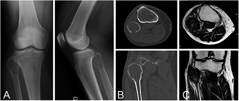 A 55-year-old male with GCTB in the proximal fibula. Plain radiographs (A) and computed tomography (B) show an osteolytic and expansive lesion. On magnetic resonance imaging, the lesion has a heterogeneous low-to-intermediate signal intensity on the T2-weighted image (C)