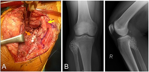 The same patient as in Fig. 1. Posterior approach to the proximal fibula. Note the common peroneal nerve was not dissected from the fibular head (yellow arrow), and β-tricalcium phosphate (β-TCP) particles were implanted from the posterior (orange arrow) (A), with retraction of the soleus muscle posteriorly. Postoperative plain radiographs after β-TCP particles were implanted in the cavity (B).