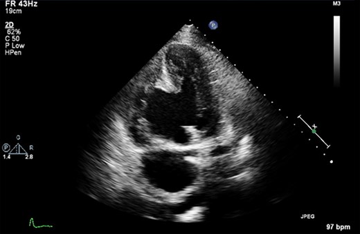 A pre-operative still from a TTE demonstrating a large VSD and a large RV aneurysm.