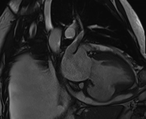 Cardiac MRI demonstrating a LV aneurysm leading to abnormal dilatation of the mitral annulus.