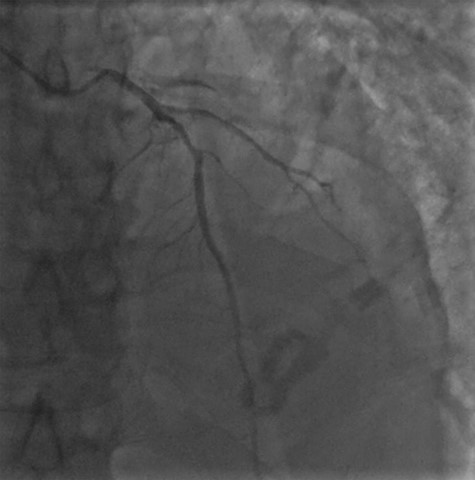 Coronary angiogram demonstrating a diffuse coronary artery disease in the distribution of the left coronary artery.