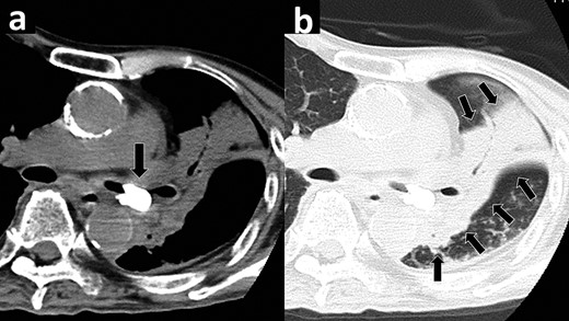 Chest computed tomography showing a bone density foreign body (arrow) in the left main bronchus (a). The left lung showing broad atelectasis (arrows) (b).