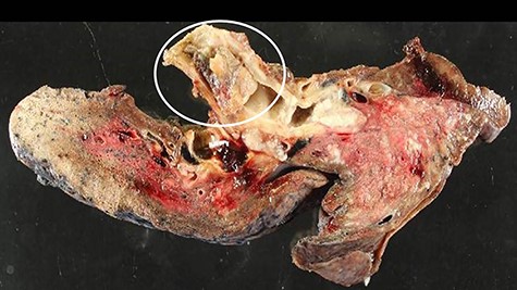 In the surgical specimen, a molar is undetachably adhered to the bronchial wall (circle).