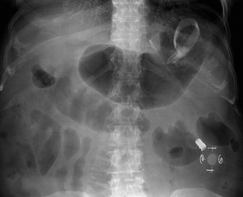 Plain film abdomen.