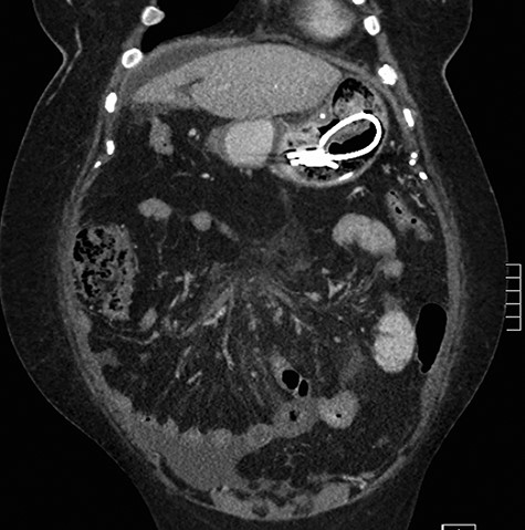 Computed tomography of abdomen and pelvis.