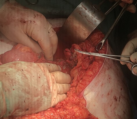 Midline laparotomy demonstrating biofilm-sealed eroded adjustable gastric band.