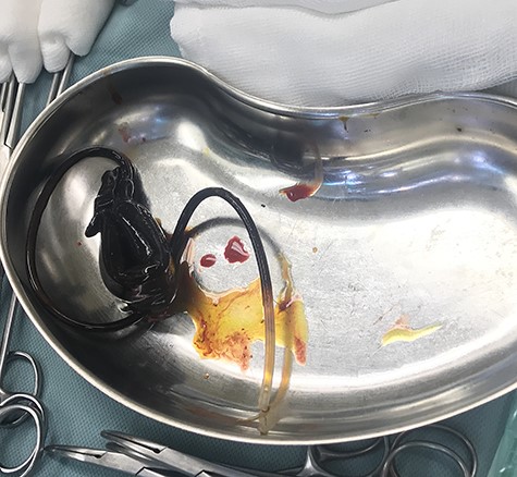 Explanted eroded gastric band device.