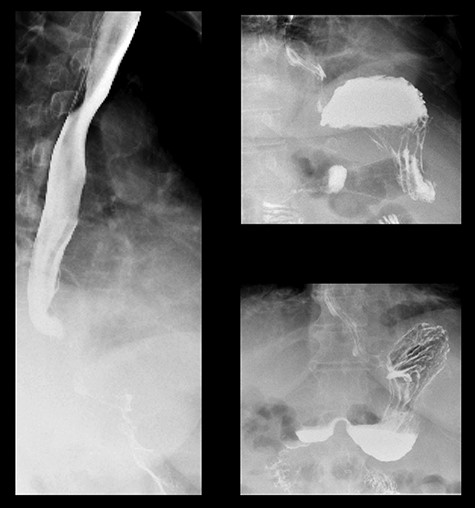 Barium meal at 3 weeks postoperatively.
