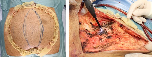 Operative view for Patient 7. Left: the skin around the tumor to be resected was ligated by inserting silk thread in an X shape. This temporarily decreases the blood flow to the tumor from the skin. Right: hemostatic procedure using the ABC.