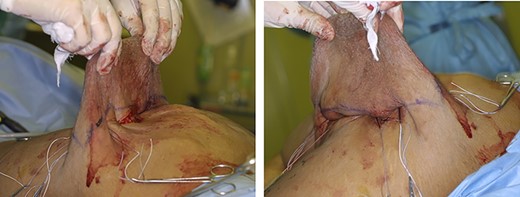 Operative view for Patient 6. The skin near the base of the tumor to be resected was ligated by inserting silk thread.