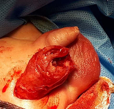 An edematous, thickened spermatic cord fascia.