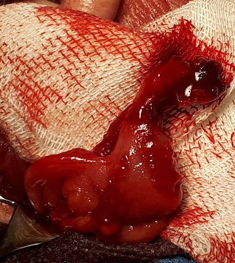Cecum and perforated appendix.