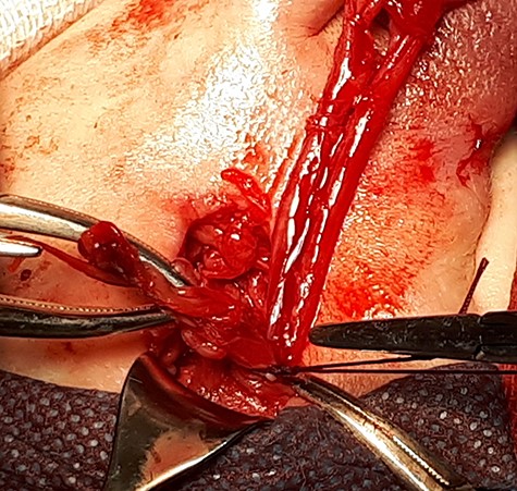 Ligation and excision of the hernia sac.