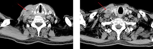 Axial CT view. Image shows a large diameter of right internal jugular vein and air bubbles inside the vessel.