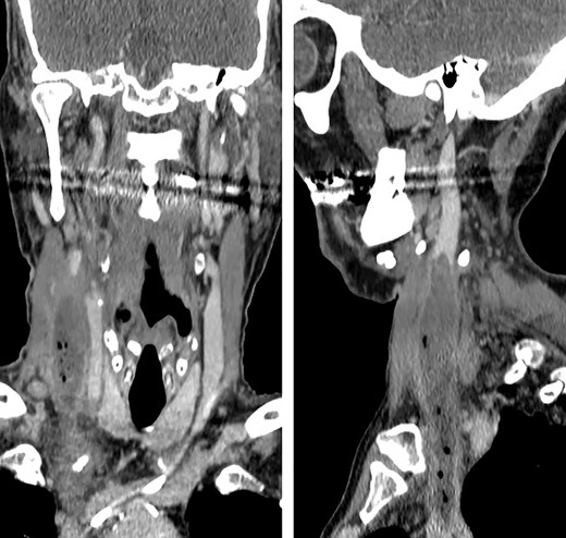 Coronal and sagittal images showing the jugular thrombosis along the neck.