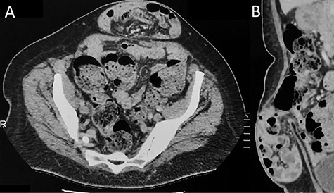 Contrast-enhanced CT imaging demonstrating an incarcerated ventral hernia containing small bowel loops. There is no evidence of associated arcuate line hernia (ALH) between the posterior rectus sheath and the rectus muscle. (A) Axial plane and (B) sagittal plane.