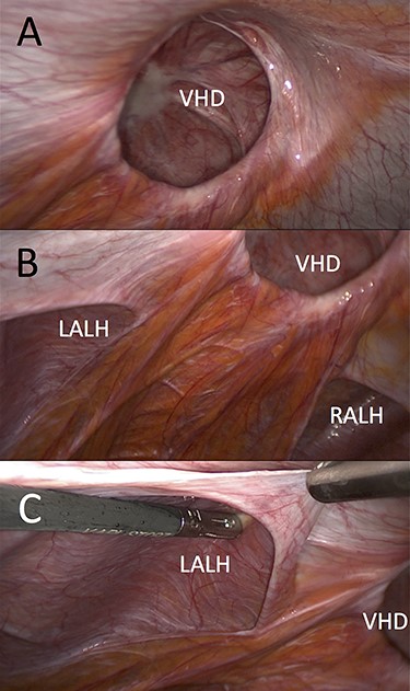 Laparoscopic view (left lateral) of ventral hernia defect (VHD) and both arcuate line hernias (ALHs). (A) Already reduced bowel content from the VHD and (B and C) clearly demonstrated left peritoneal fold (LALH).