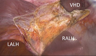 Peritoneum incised above arcuate lines and associated hernia sacs reduced.