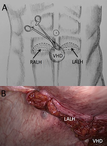 (A) Illustration of trans-ventral hernia defect (VHD) closure of both arcuate line hernias (ALHs) using a “traction” Moynihan forceps and (B) laparoscopic view of the primarily closed left ALH with closed VHD in the background.