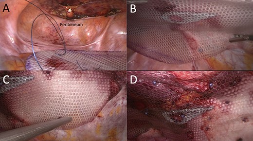 Partially preperitoneal placement of 15 × 25 cm composite polyester mesh. (A) Caudal view of the opened preperitoneal space; (B) mesh adjustment using transfacial sutures; (C) mesh fixation with absorbable Securestraps and (D) final laparoscopic view of repair.