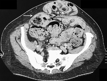 Axial view of contrast-enhanced CT scan showing a small opening (>) with ascending protrusion of bowel between the posterior rectus sheath (black arrow) and the rectus muscle (white arrow).