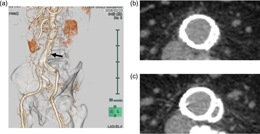 a. Postoperative CT image with three-dimensional reconstruction showing a marked compression of the contralateral leg by the bridging device in the terminal aorta, which is visible only in the left anterior oblique view. b. Postoperative axial CT image at the level of the black arrow shows a marked compression of the contralateral leg in the terminal aorta. c. Postangioplasty axial CT image shows the alleviated compression. CT, computed tomography.