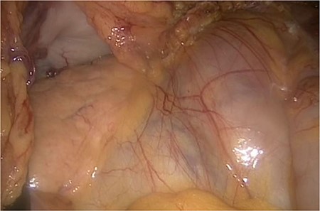On the left side, we show the retroperitoneal pancreas, with the (as well) retroperitoneal jejunum on the right side.