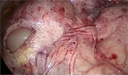 Dorsal peritoneum covering the entire ileum.