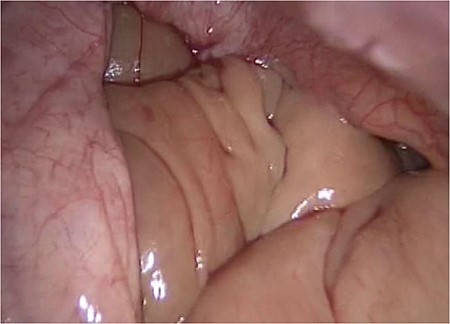 Retroperitoneal view, showing the ileum.