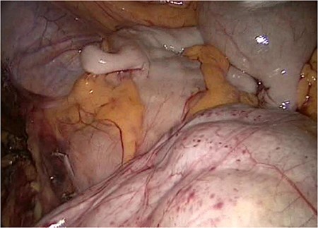 The slim intraperitoneal appendix in the left upper corner with the covered terminal ileum. In the right lower corner, the covered ileum convulse is seen.