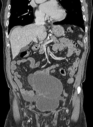 Cross sectional computed tomography image showing a large cystic, trabeculated lesion with an enhancing wall in the lower abdomen measuring 11.3 × 11.5 × 16 cm.
